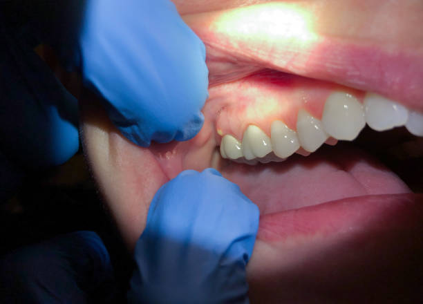 Best Emergency Treatment for Oral Infections in Newport Beach, CA